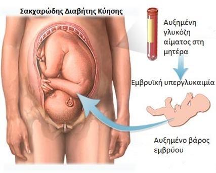 diabetesgestational